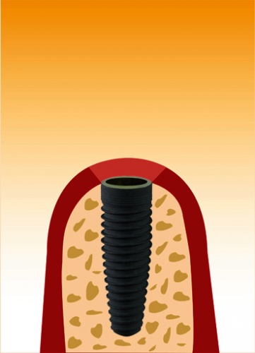 implantat2