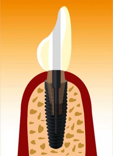 implantat4