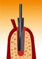 implantat1
